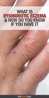 I would never recommend being. 19 Dyshidrotic Eczema Ideas Eczema Eczema Remedies Eczema Treatment