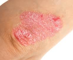 Image result for psoriasis