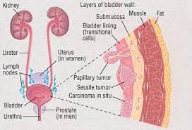 Bladder Cancer Harvard Health
