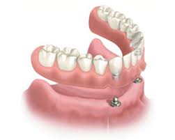 Dentures that are too big can be hard to wear and may lead to you not wanting to wear your dentures at all. Can You Keep A Snap On Denture In While You Sleep Dentistry By Brooksher
