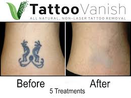Latest Tattoo Removal Laser Pen Tattoo Removal Tattoo Removal Eyebrow Tattoo Removal Laser Tattoo Removal Laser Tattoo