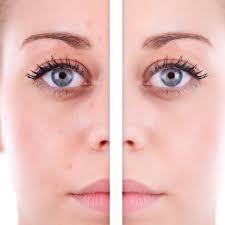 Undereye Brightening