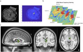 Image result for Thalamic Stimulation