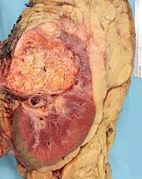 Over 14,000 americans will die from the disease this year, but with advancing treatments, many more will extend their life and vitality. Renal Cell Carcinoma Wikipedia