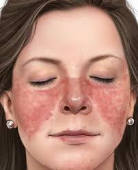 This meat pie be like watin get eczema 😂