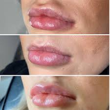 Maybe you would like to learn more about one of these? Has My Lip Filler Migrated Are My Lips Normal L1p