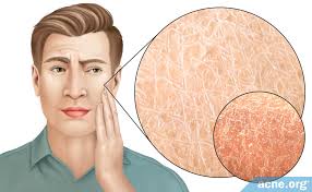 Image result for Dry Skin