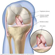 Acl injuries most commonly occur during sports that involve sudden stops, changes in direction, and jumping— such as soccer, football, basketball treatment may include rest, rehabilitation and activity limitations, or surgery to replace the torn ligament. Acl Injury Symptoms And Causes Mayo Clinic