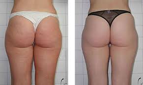 ( sur les fesses et les cuisses ) ou autres ? Comment Ne Plus Avoir De Cellulite 7 Manieres Ventre Plat Conseils