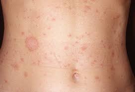 Pityriasis rosea, a rash that usually appears on the torso, upper arms, thighs or neck, may sound worse than it really is. Picture Of Pityriasis Rosea
