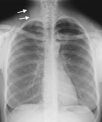 Unilateral Hyperlucent Hemithorax Chest Radiology The Essentials 2nd Edition