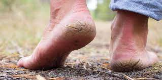 Tips On How To Fix Dry Cracked Heels Quickly At Home Gadjetx