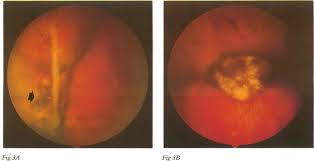 What happens during surgery for a detached retina or tear A Six Months After Treatment Of A Retinal Break During Retinal Download Scientific Diagram