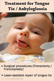 Image result for Ankyloglossia