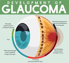 Currently, the only treatment option is to lower eye pressure, whether that be through medications, laser, or surgery. Glaucoma Springfield Glaucoma Treatment Greenfield