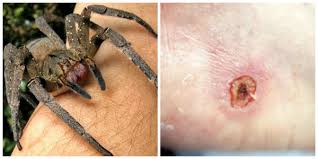 Image result for Tarantula Bite
