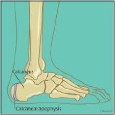 Image result for Calcaneal Apophysitis