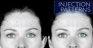 Some muscles pull the eyebrows down (the orbicularis oculi and the corrugator. Best Tried And Tested Botox Injection Patterns Dr Tim Pearce