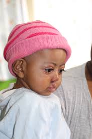 Transforming Lives in Ethiopia: Dr. Robert Glade and the Free to Smile  Foundation