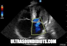 Image result for Restrictive Cardiomyopathy