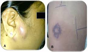 Then, there is no sense in placing a ppd skin test again, as you already know. A Parotid Tuberculosis With Surrounding Redness B Positive Ppd Test Download Scientific Diagram