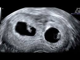 By four weeks, twins will start showing during ultrasound in form of 2 gestational sacs, but you cannot get clear indication of twins until 6 weeks. Pin On My Ultrasound Board Ideas