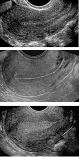 Transabdominal pelvic ultrasound can detect most larger abnormalities such as large fibroids, ovarian cysts, neoplasms, etc. Recent Updates In Female Pelvic Ultrasound Springerlink