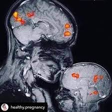 Joy of Mom on X: This is the world's first magnetic resonance image  showing the connection between a mother and child. 💞This image of  neuroscientist Rebecca Sax kisses her 2
