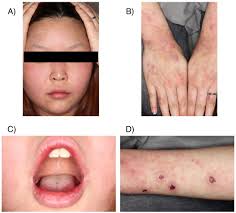 A concise review with a comprehensive summary of therapeutic interventions emphasizing supportive measures.advther. Comorbidity Of Stevens Johnson Syndrome And Neutropenia Associated With Lamotrigine A Case Report Sciencedirect