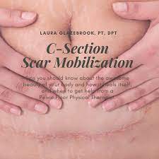 Is My C Section Scar Healing Well One On One Physical Therapy