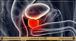 يعتبر البروستات أخطر السرطانات التي تهدد حياة الرجال بعد سرطان الرئة، لكثرة انتشاره، لكن القضاء عليه لم يعد مستحيلا بعد اكتشاف ويؤكد مطورو العلاج الجديد أن المرضى لن يعانوا من أعراض جانبية تذكر لعلاج سرطان البروستات مثل أعراض العلاج بالجراحة أو الإشعاع. Ø³Ø±Ø·Ø§Ù† Ø§Ù„Ø¨Ø±ÙˆØ³ØªØ§ØªØ§ Ø£ÙØ¶Ù„ Ø·Ø±ÙŠÙ‚Ø© Ù„Ø¹Ù„Ø§Ø¬ Ø³Ø±Ø·Ø§Ù† Ø§Ù„Ø¨Ø±ÙˆØ³ØªØ§ØªØ§ 2021