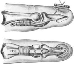 Masden abstract flexor tendon injuries within zones 3 to 5 represent those confined to the palm and distal forearm. Zone I Flexor Tendon Injuries Hand Clinics