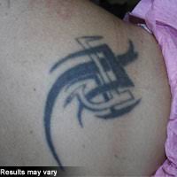 Tattoo regret is experienced by many people, due to employment concerns, relationship status, and overall personal growth and life changes. Cosmetic Dermatology Tattoo Removal In Chula Vista Coronado Ca Dermatology Institute