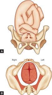Image result for Manual Rotation in Occipitoposterior Presentation