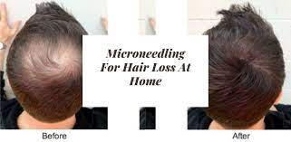 From microneedling alone, you will look plump, pink but microneedling also promises improvement over time. Microneedling For Hair Loss At Home The Useful Information Hair Hip
