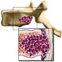 Hemangioamele hepatice sunt cel mai frecvent tip de tumora benigna a ficatului. Tratamentul Hemangioamelor De Localizare DiferitÄƒ La AdulÈ›i Hemangioame La AdulÈ›i Cauze È™i Tratamentul Unei Tumori Vasculare