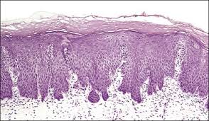 Clinical significance of squamous metaplasia in the cervix in the cervix, the area of the epithelium that has undergone metaplastic change is called the transformation zone (tz). Cervical Benign And Non Neoplastic Conditions Basicmedical Key