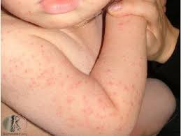 Maybe you would like to learn more about one of these? Menyusuri Kembara Cetusan Jiwa Kimi Demam Campak Rosela Infantum