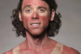 ‫درمان آفتاب سوختگی صورت: علائم، درجات و مدت درمان -دکترمایکو‬‎