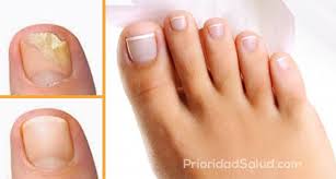 Hongos En Las Uñas De Las Manos Como Eliminarlos Como Eliminar Los Hongos De Las Unas Rapidamente Make Up How To Make Tips