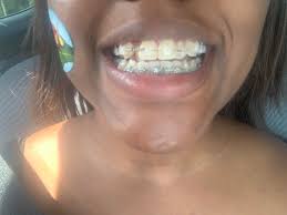 How long will braces hurt? Officially Part Of The Braces Clubs Few Questions To Add How Long Will The Soreness Last Got Them 9 30 19 How Long Before You Saw Changes In Your Teeth Smile Any Tricks To Help