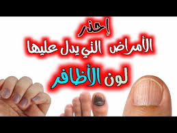 هل تعلم ما هي الأمراض التي يشير لها لون الأظافر هناك أمراض خطيرة Youtube