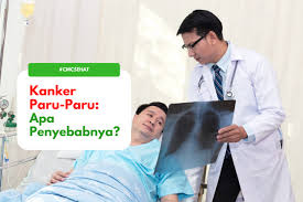 Faktor Penyebab Kanker Paru Paru Agar Anda Terhindar Dari Penyakit Ini