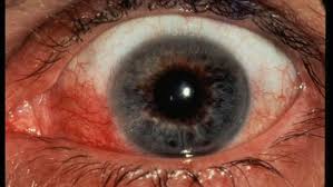 Image result for Acute Red Eye