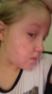 Does advantage cause seizures in dogs?