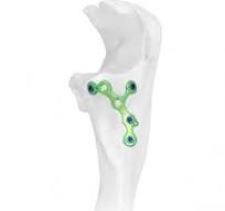 VA Oblique L-shape Locking Plate,Medical Device & Implants ...