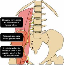 Image result for Obturator Nerve Compression