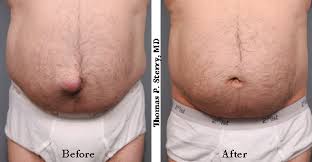 Belly Button Plastic Surgery In Nyc Plastic Surgery News For New York City From Dr Thomas P Sterry