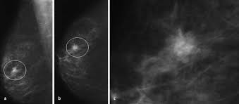 Radiologische Diagnostik Des Mammakarzinoms Springerlink