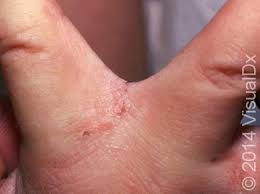 Image result for scabies human children